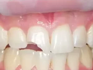 باندینگ دندان