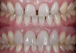 ریمو کردن کامپوزیت دندان