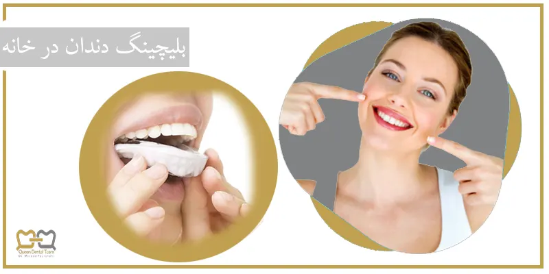 این روش توسط بهترین متخصص دندانپزشکی و همینطور خود افراد در خانه انجام خواهد شد. ابندا قالبی از دندان ها تهیه شده و برای ساخت تری های پلاستیکی نازک و شفاف به آزمایشگاه فرستاده خواهد شد. پس از آماده شدن این تری ها که با توجه به فضای مناسب بین دندان ها ساخته شده و همینطور ژل های بلیچینگ به فرد تحویل داده شده و آن ها با استفاده از آن ها طبق دستور دندانپزشک به مدت چند هفته دندان ها سفید خواهند شد.